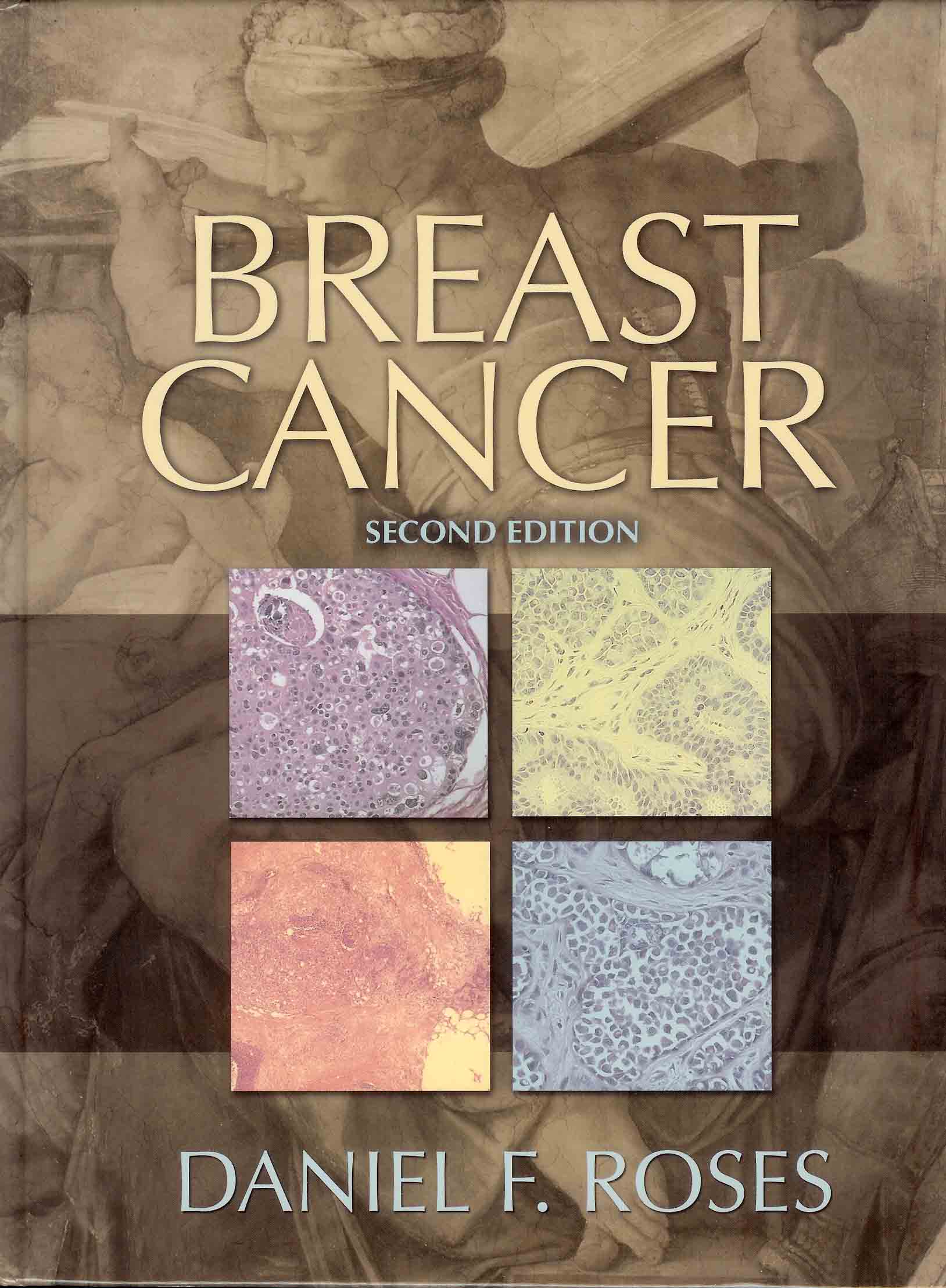 Breast Cancer-2판