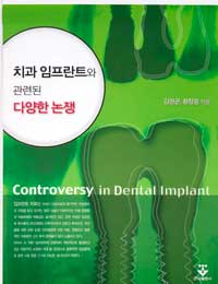 치과 임프란트와 관련된 다양한 논쟁