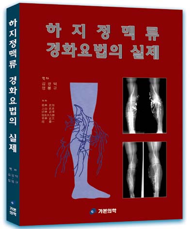 하지정맥류 경화요법의 실제
