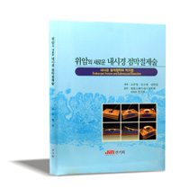 위암의 새로운 내시경점막절제술