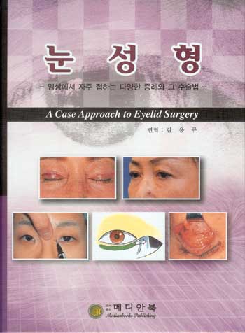 눈성형 - 임상에서 자주 접하는 다양한 증례와 그 수술법