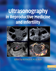 Ultrasonography in Reproductive Medicine and Infertility-1판