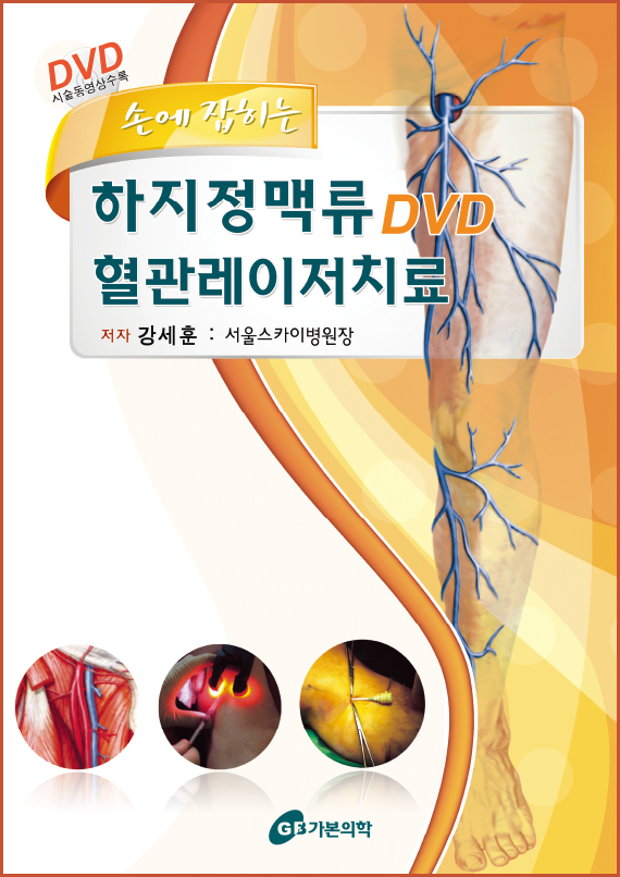 손에잡히는 하지정맥류DVD 혈관레이저치료