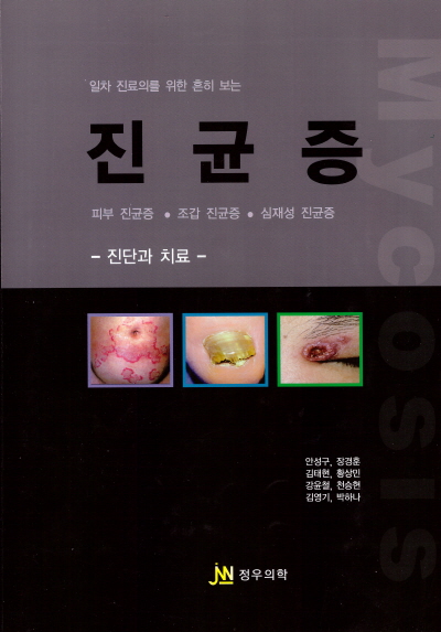 진균증 - 일차 진료의를 위한 흔히 보는