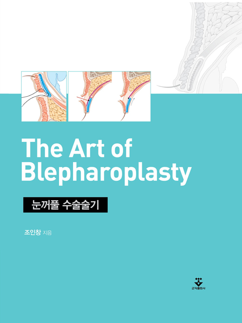 눈꺼풀 수술술기(보완판)