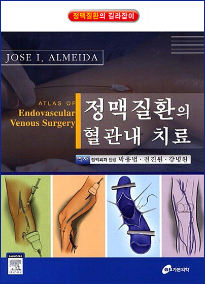 정맥질환의 혈관내치료