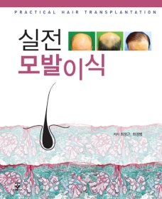 실전모발이식