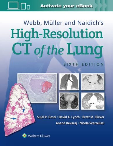 High-Resolution CT of the Lung-6판