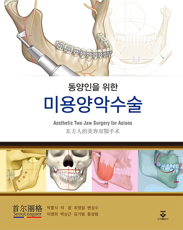 동양인을 위한 미용양악수술