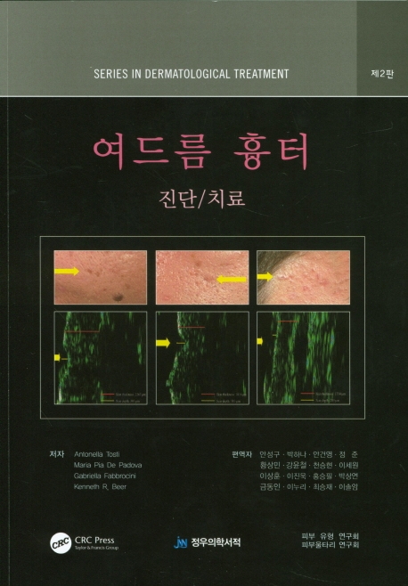여드름 흉터 진단 치료
