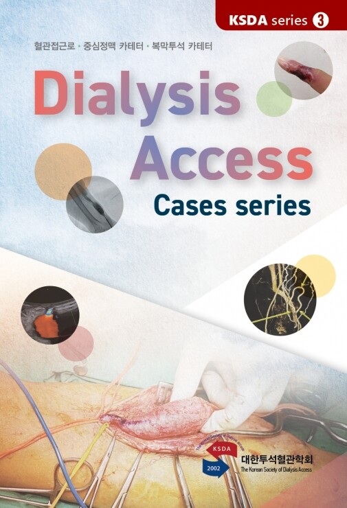 Dialysis Access