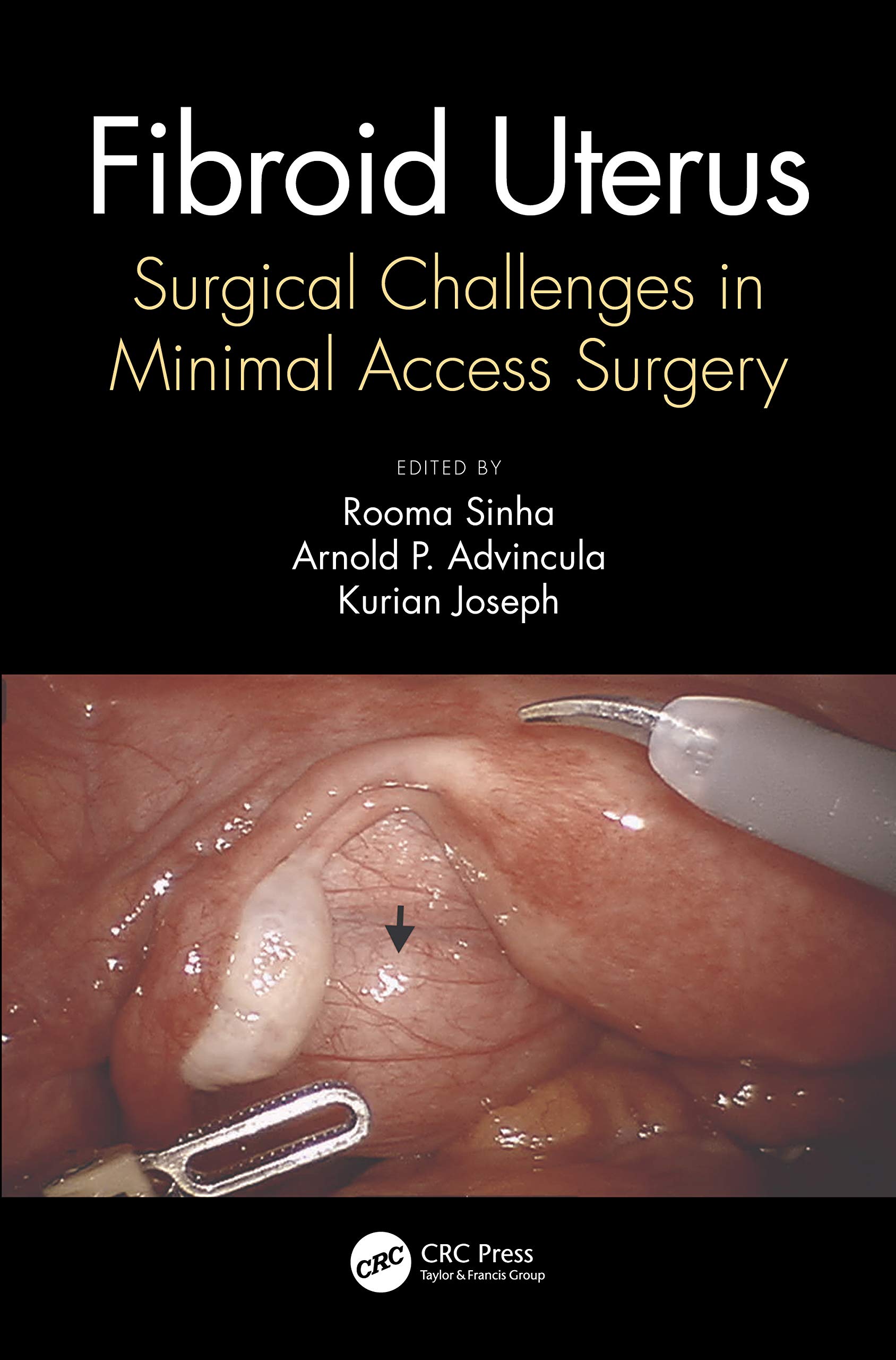 Fibroid Uterus-1판(Softcover)