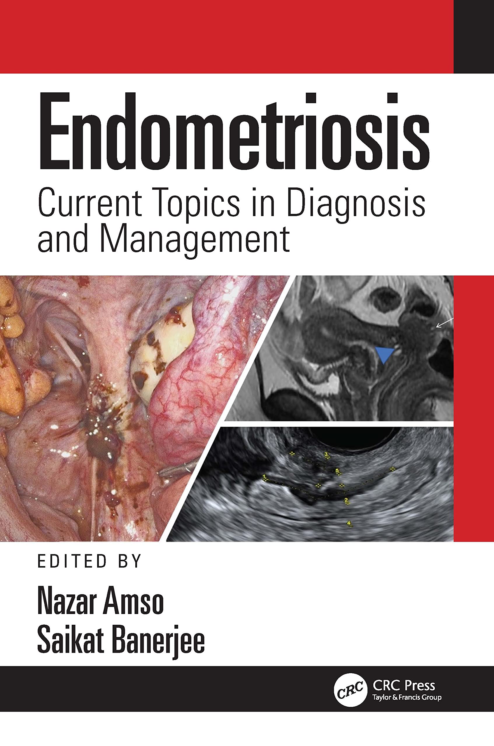 Endometriosis: Current Topics in Diagnosis and Management-1판