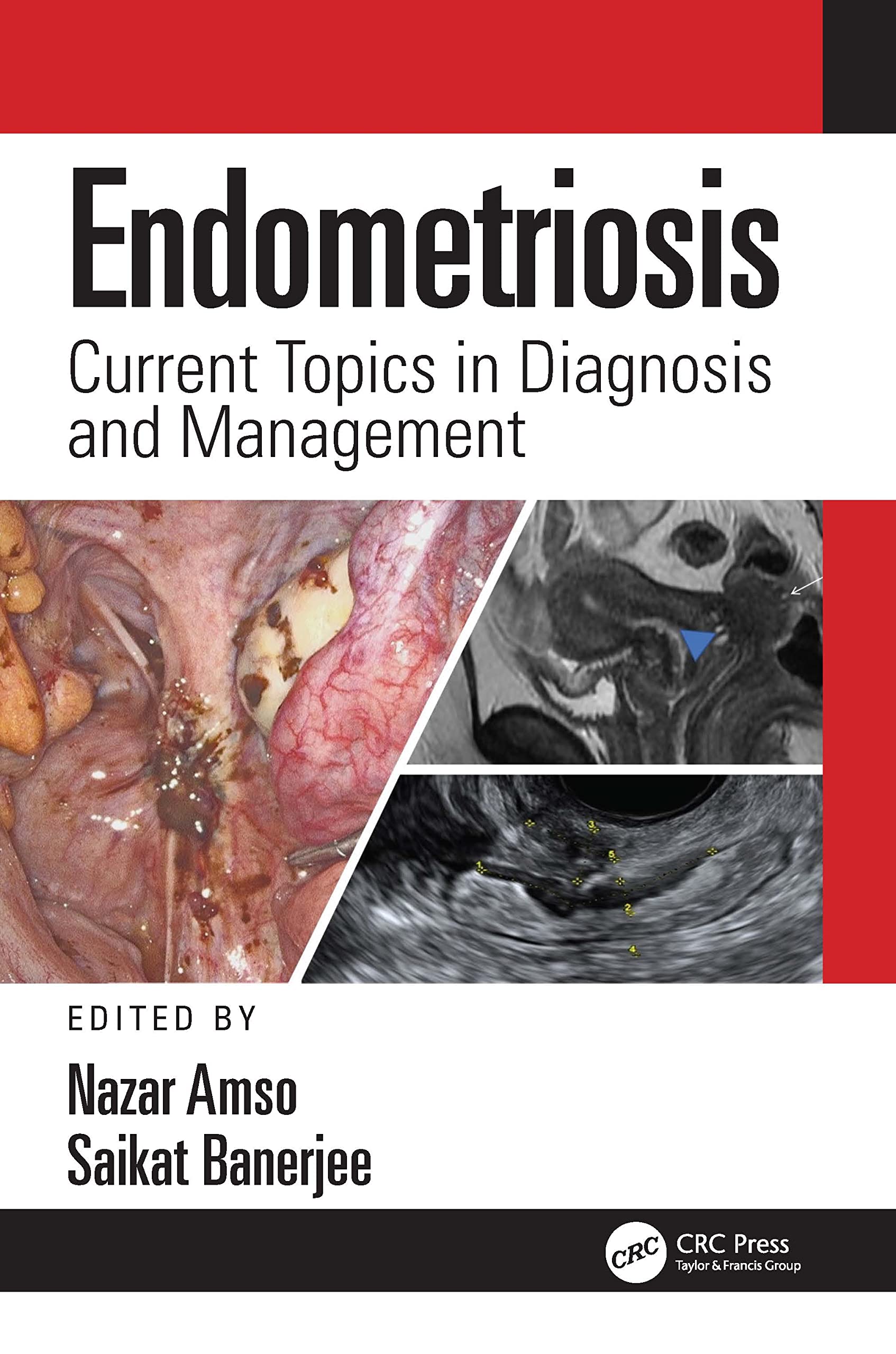 Endometriosis: Current Topics in Diagnosis and Management-1