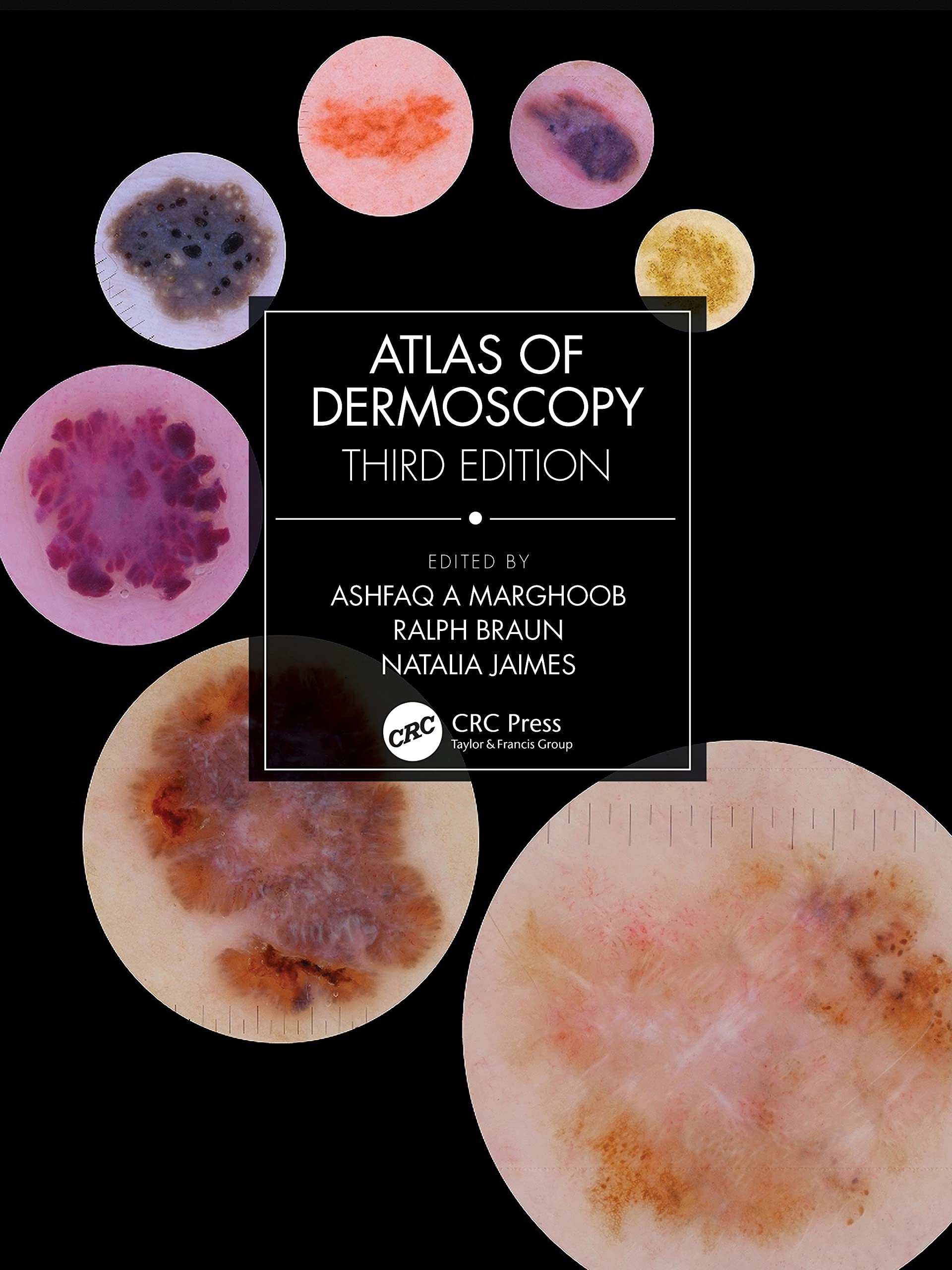 Atlas of Dermoscopy - 3판