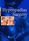 Hypospadias Surgery