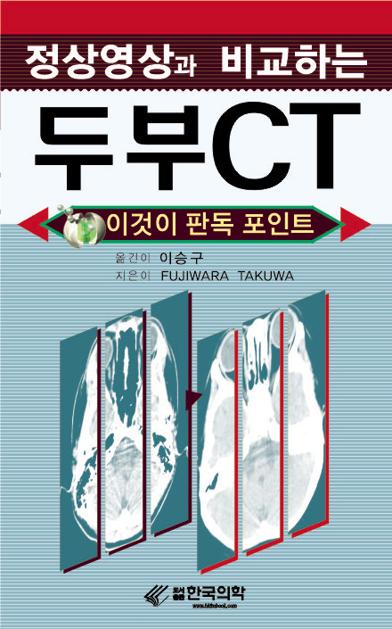 정상영상과 비교하는 두부CT
