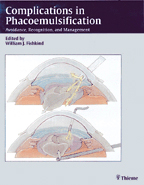 Complications in Phacoemulsification